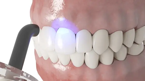 dental bonding near you