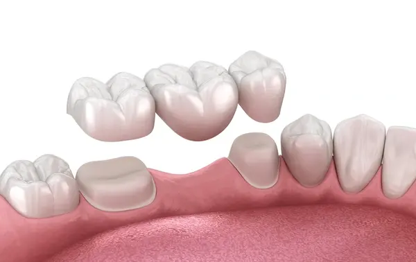 dental bridges in port coquitlam
