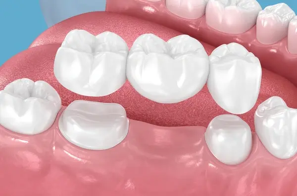 dental bridges near you