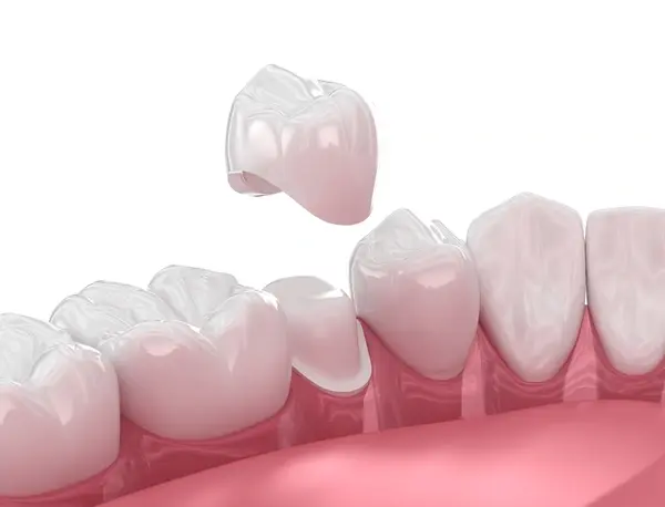 dental crowns in port coquitlam