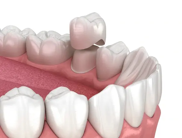 dental crowns near you