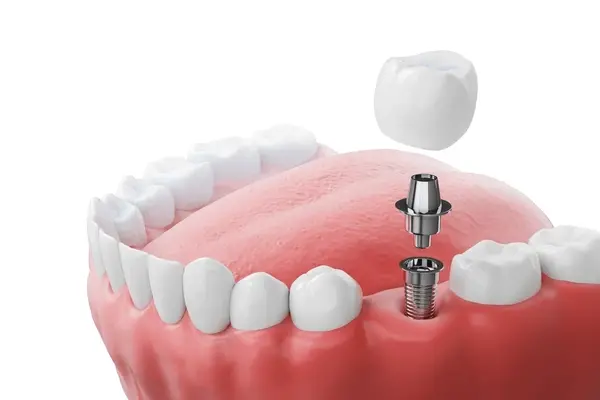 dental implants in port coquitlam