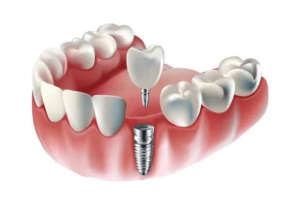 dental implants near you