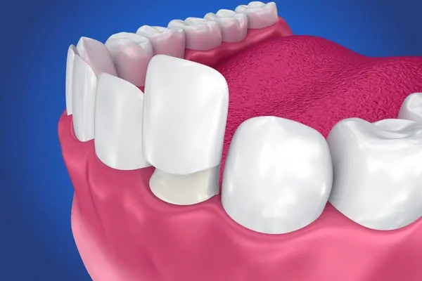 dental veneers in port coquitlam