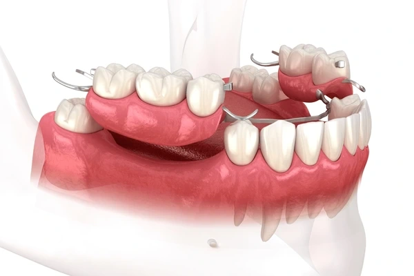 partial dentures in port coquitlam