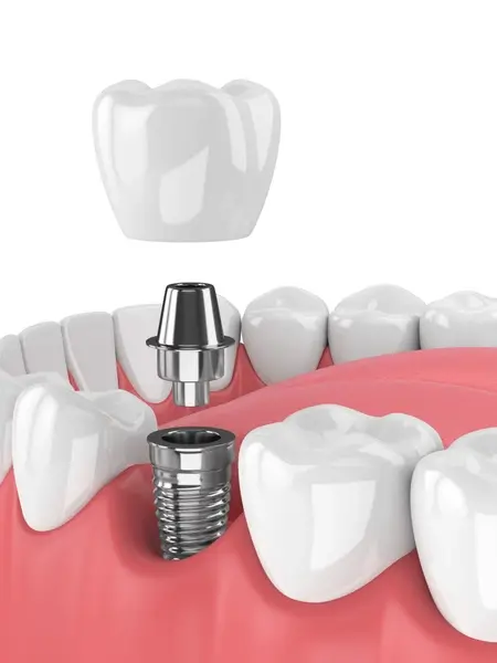 replacement for missing teeth near you