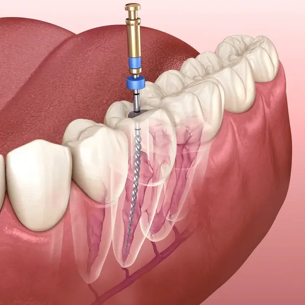 root canal therapy in port coquitlam