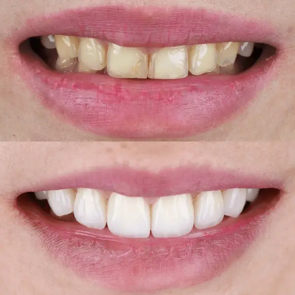 smile makeovers in port coquitlam