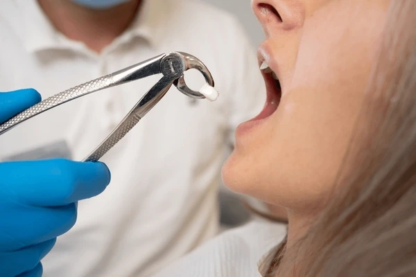 tooth extractions in port coquitlam