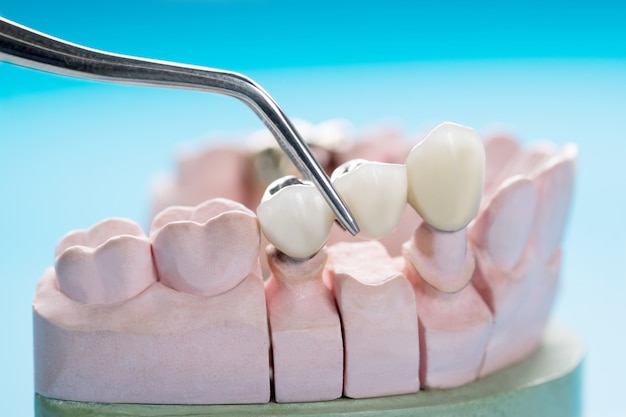 how dental bridges restore tooth